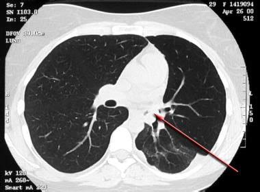 chest x-ray to diagnose asthma|Chest Radiographs And CT Scans For Asthma Analysis.